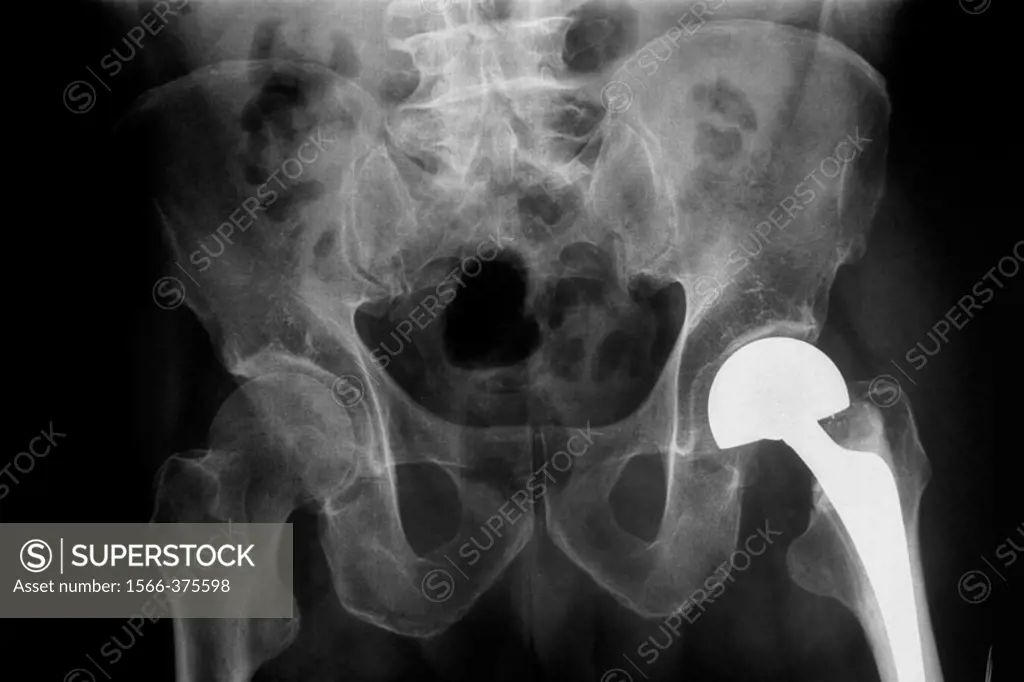 Hip prosthesis.