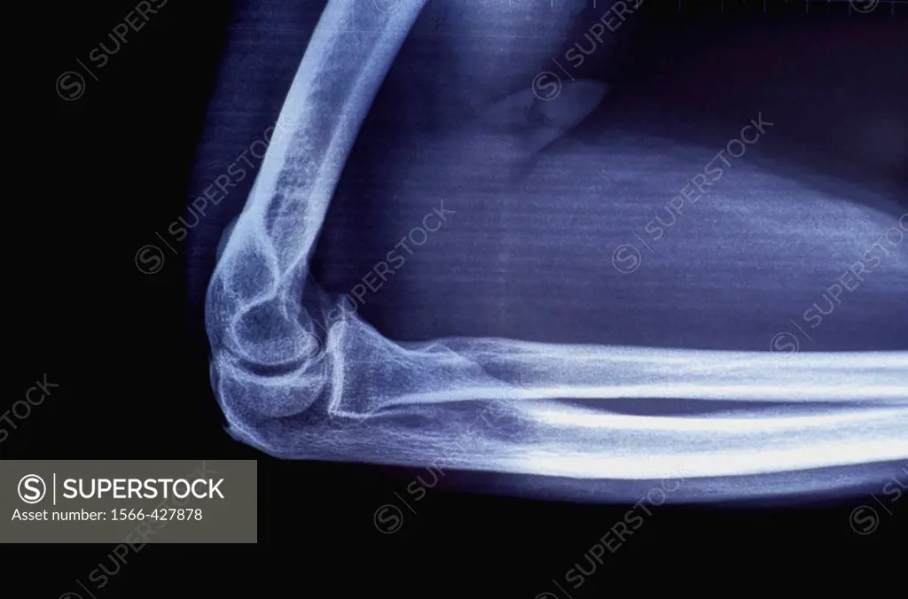 X-Ray, arm and elbow