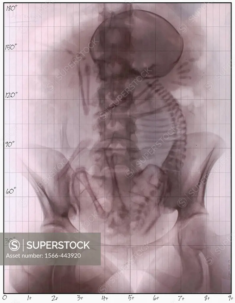 X-Ray of fetus
