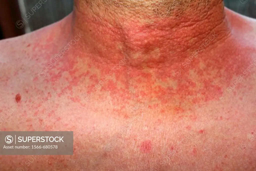 Red skin rash on a man with scarlet fever or fever or dermititis