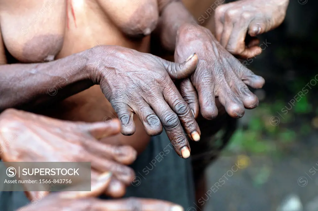 Local Papuan women, showing her fingers cut according to local customs, Baliem Valley festival, Jayawijaya region, Papua, Indonesia, Southeast Asian