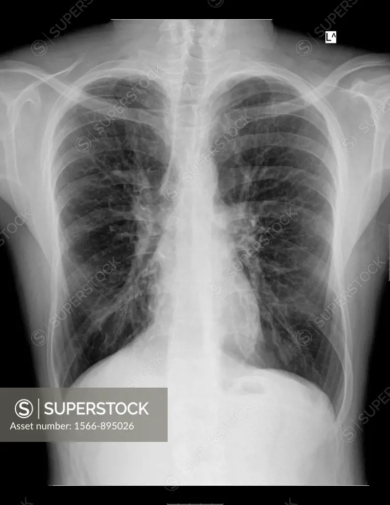 Chest X-ray of a 28 year old male patient suffering from Dyspnea due to Cystic Fibrosis and drug induced Osteoporosis