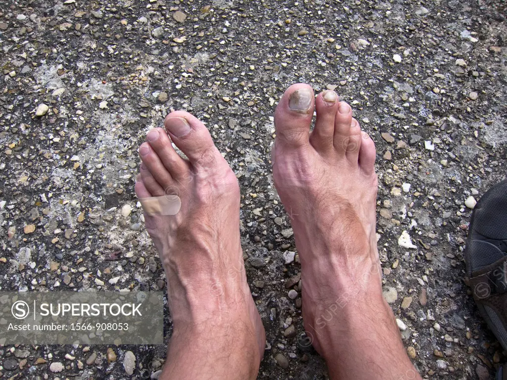 Persons feet with blisters