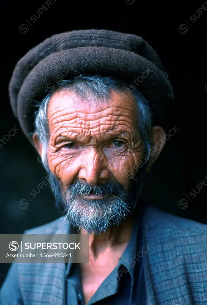 Man suffering from cretinism, a common disease in northern Pakistan. Cretinism is characterized by mental deficiency, dwarfism, dry skin.