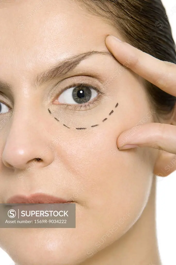 Woman with plastic surgery markings under one eye, touching face, looking at camera