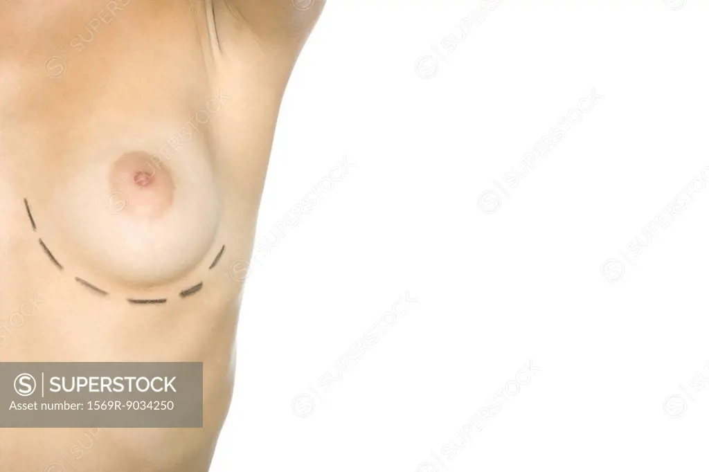 Woman with plastic surgery markings under breast, cropped view