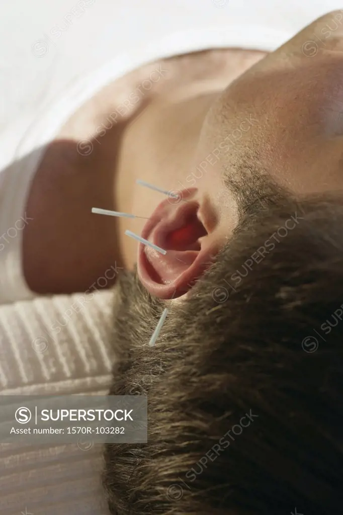 Close-up of man receiving acupuncture on ear