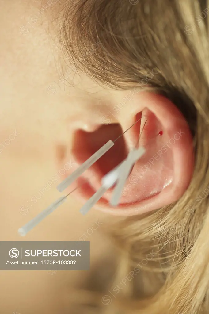 Close-up of woman receiving acupuncture on ear