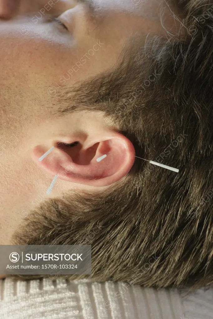 Man receiving acupuncture on ear