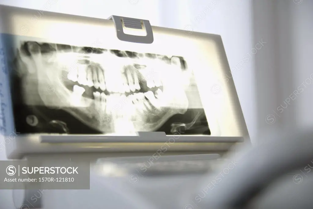 Dental X-ray on a light box