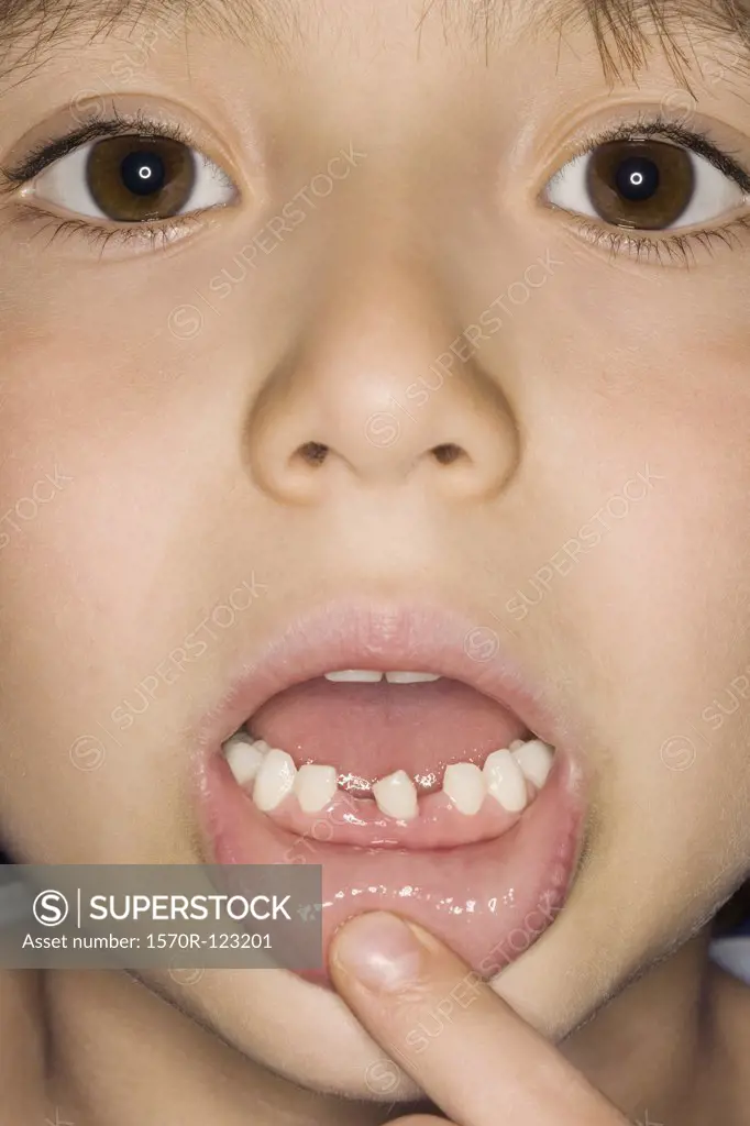 A boy showing his missing teeth