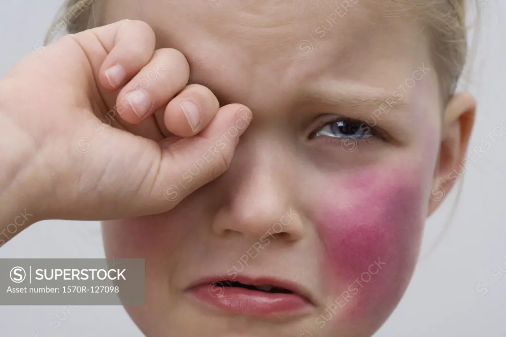 A little girl with a bruise on her cheek crying
