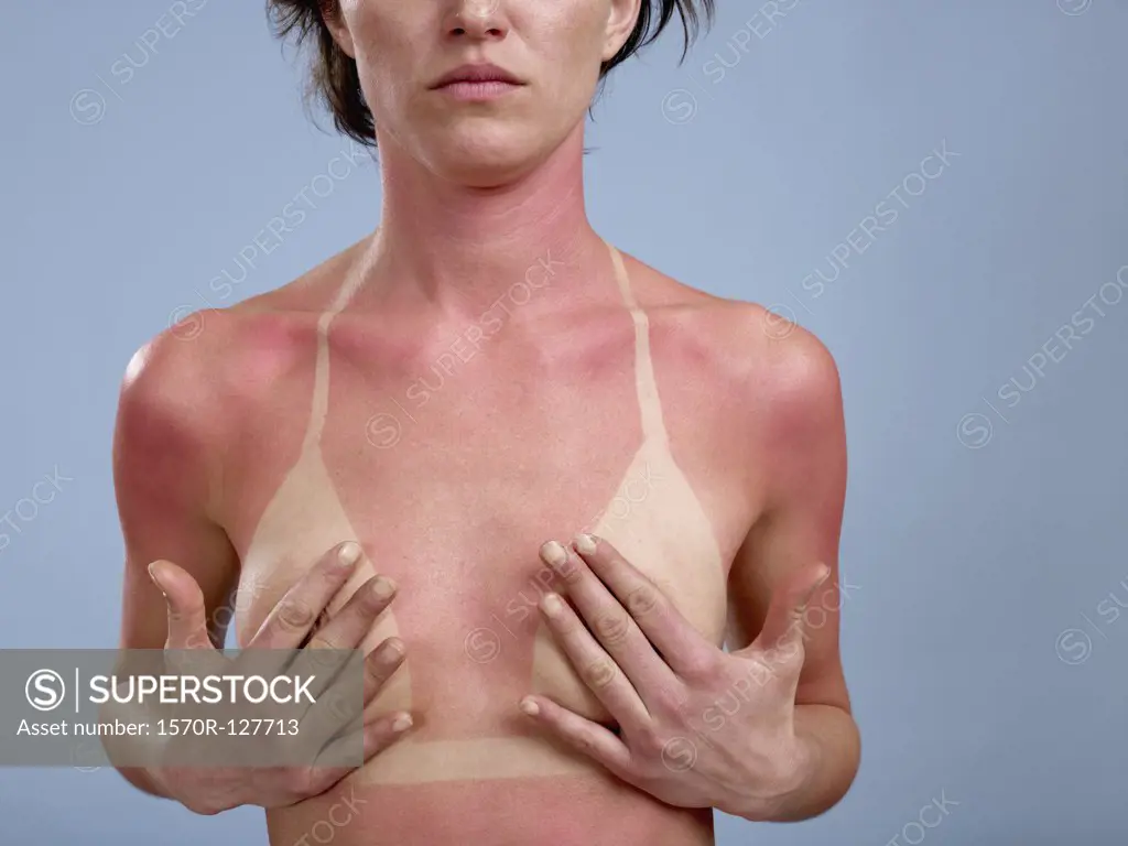 A sunburned woman