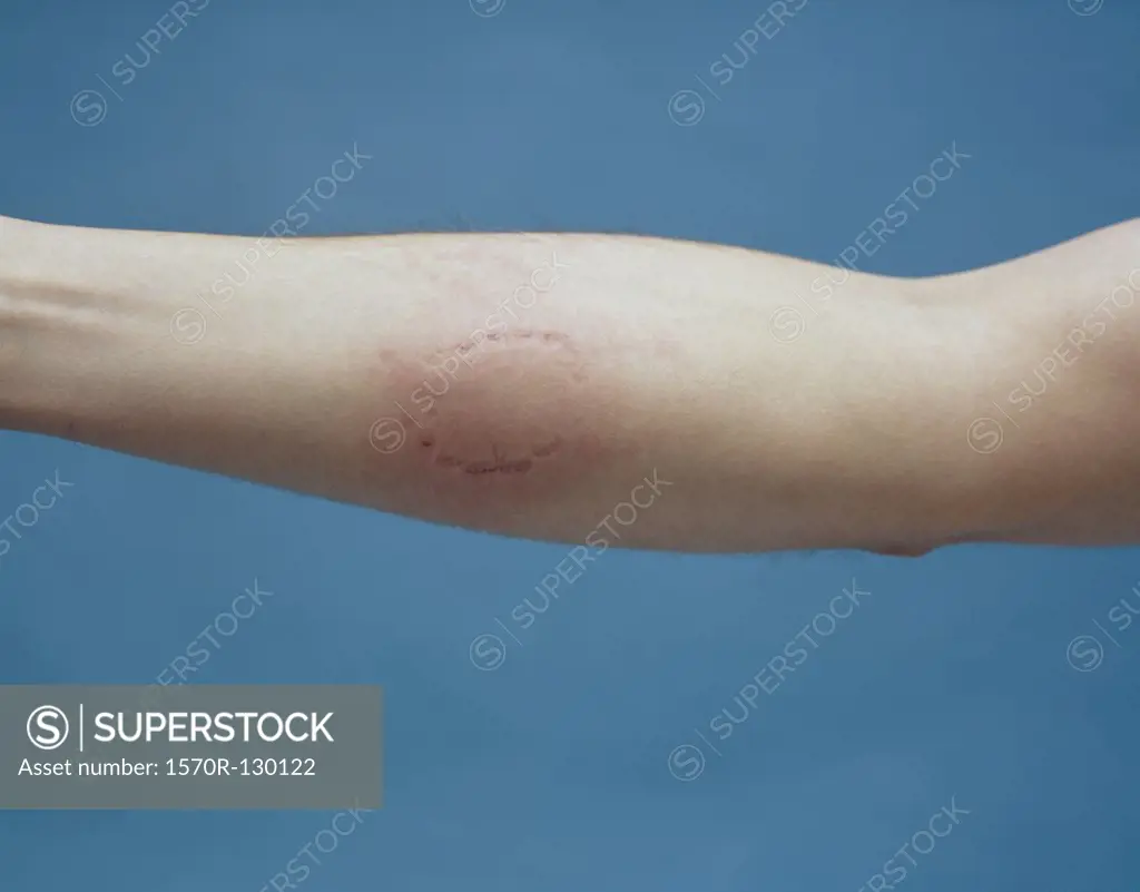 Human arm with bite mark