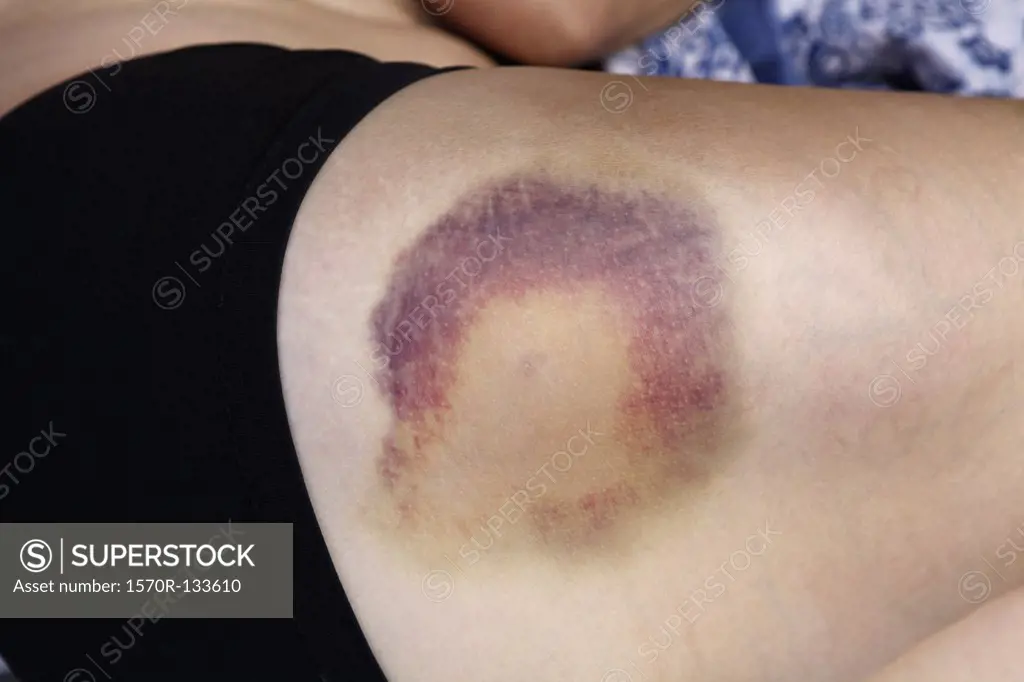 Detail of a bruise on the thigh of a woman