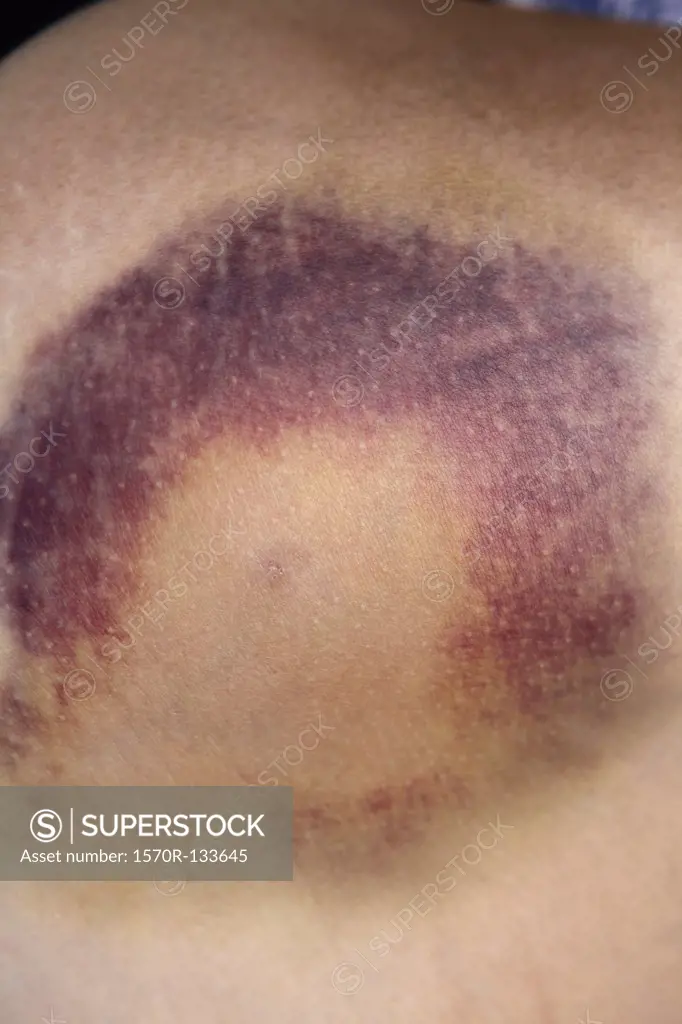 Detail of a bruise on the thigh of a woman