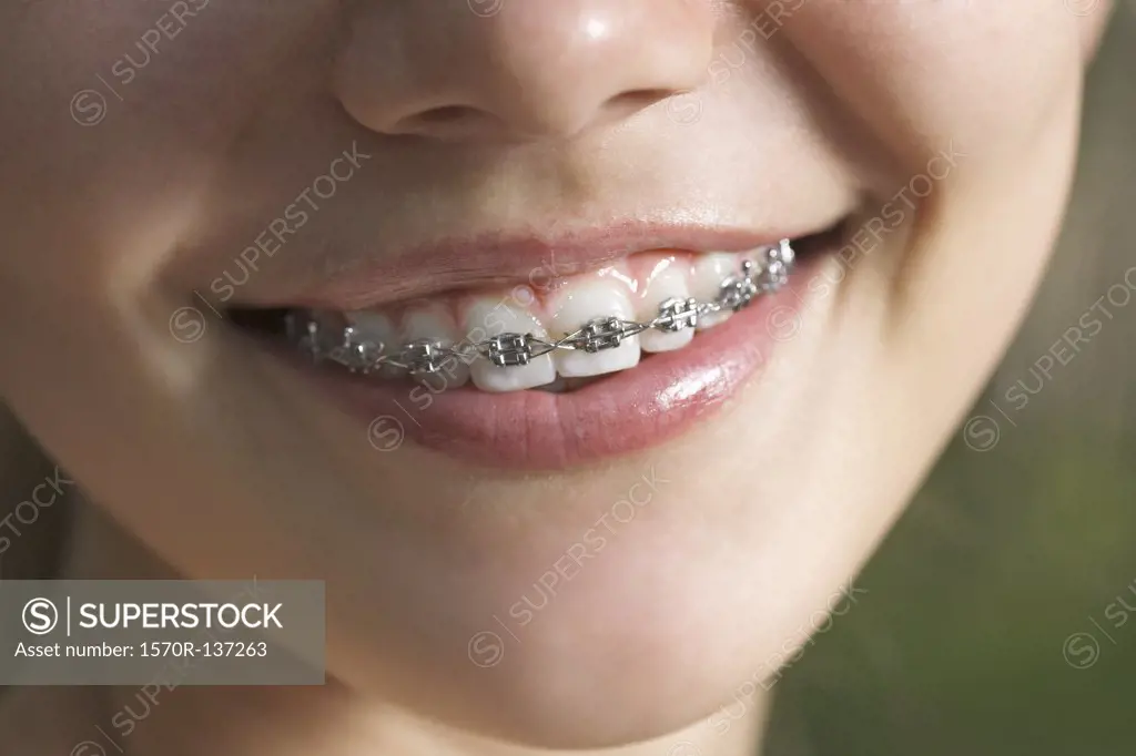 A smiling teenager with dental braces, ECU