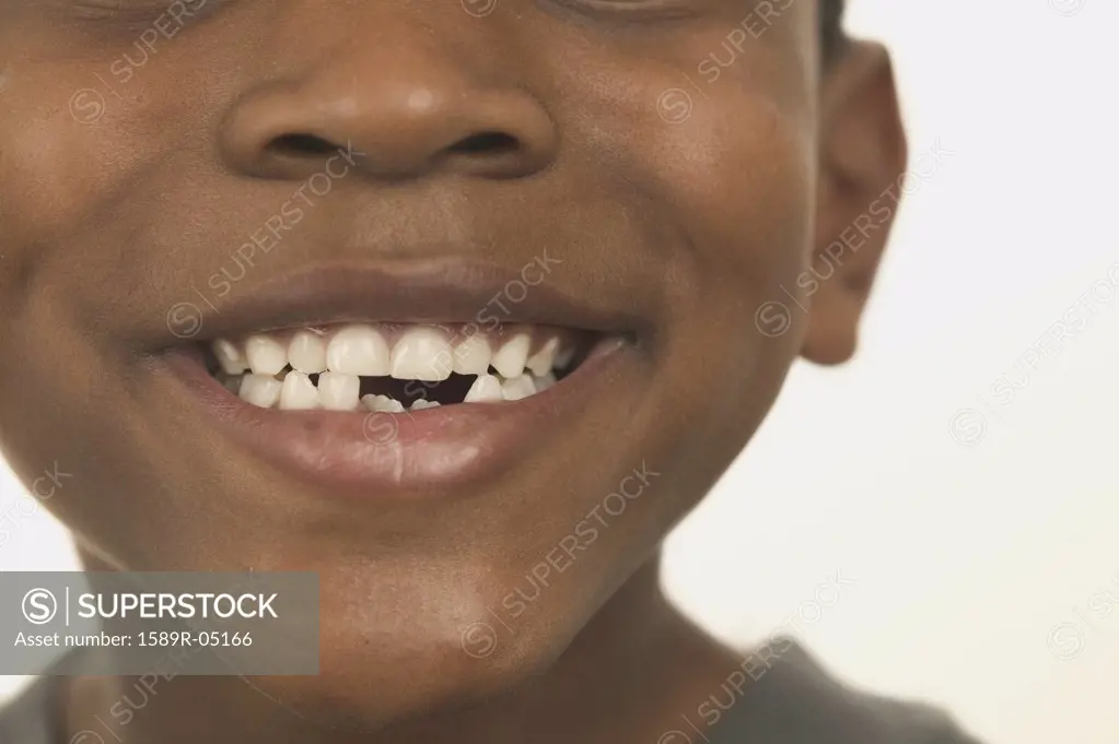 Close-up of a young boy smiling with broken teeth