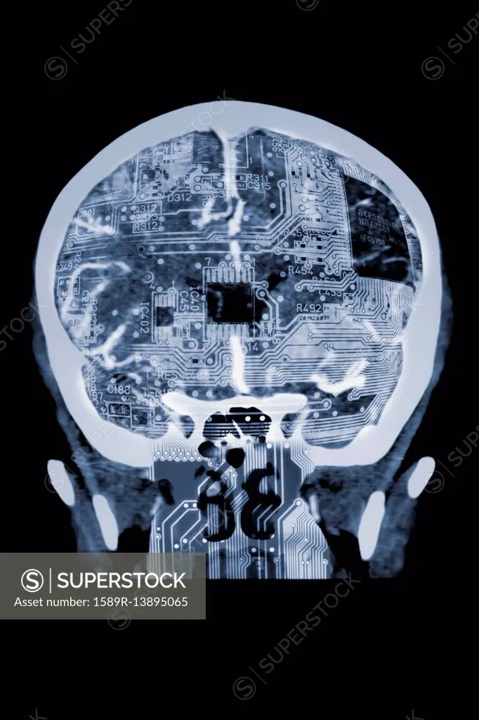 Circuit board in x-ray of skull