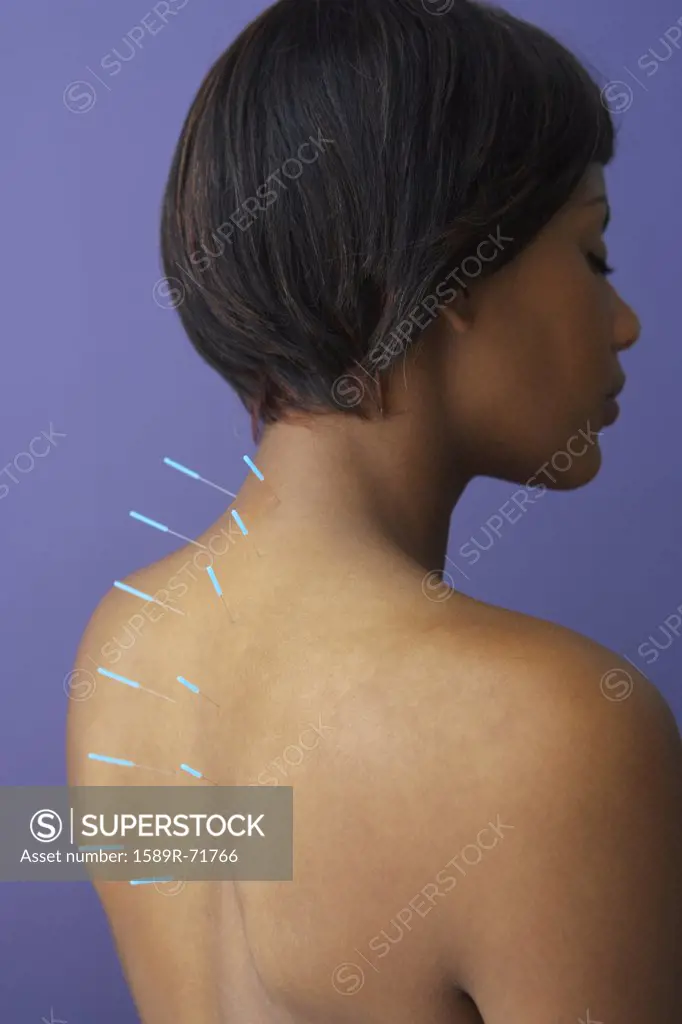 Acupuncture needles in African woman's back