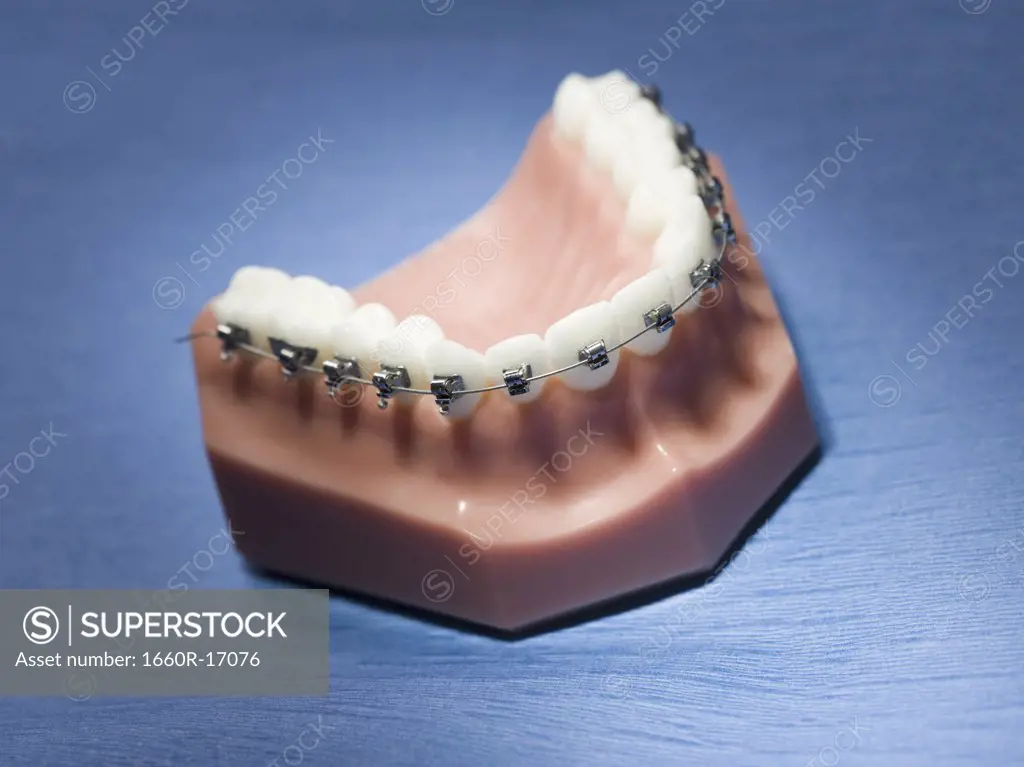 False teeth with braces