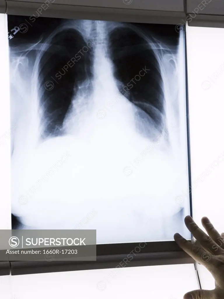 Chest x-ray with male hand