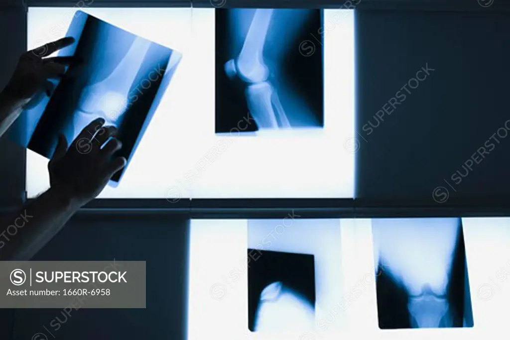 Person's hand positioning an X-Ray