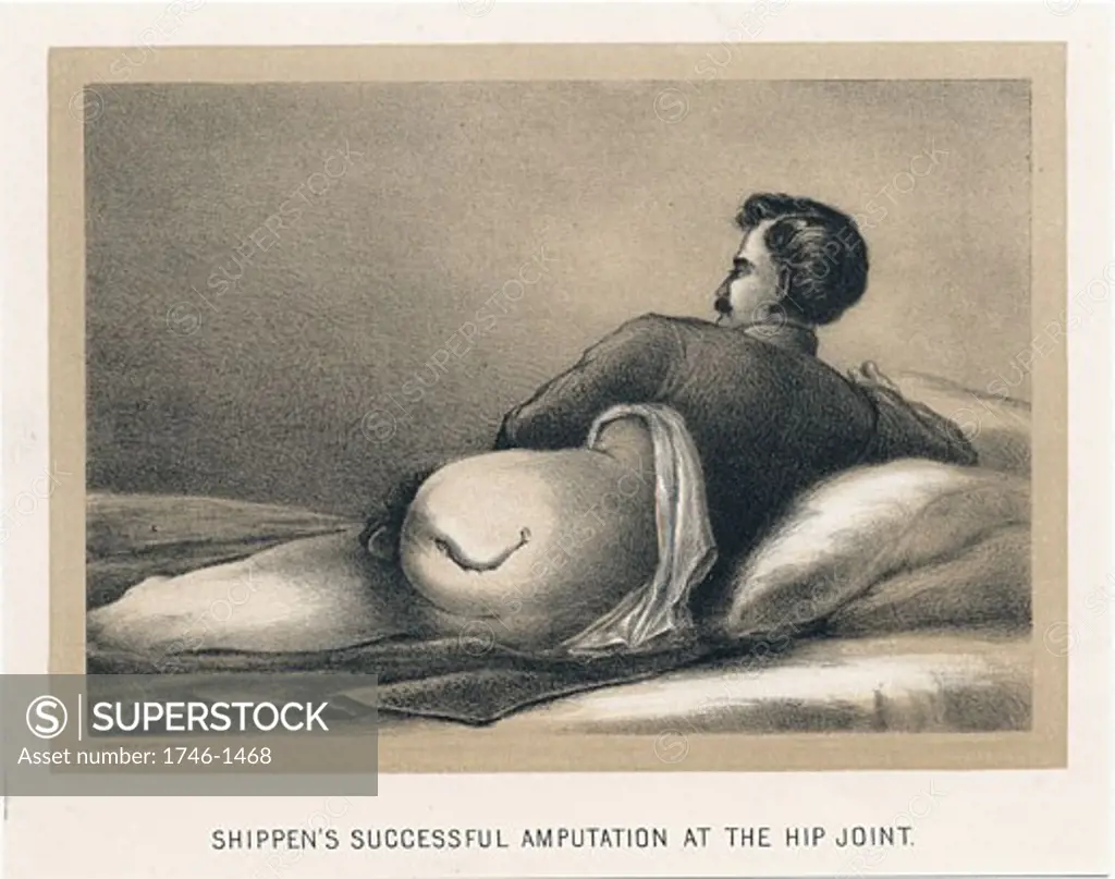Successful amputation at the hip joint on casualty in American Civil War. Mortality from this procedure was in excess of 70%. Shippen's amputation. From Circular No.6, Surgeon General's Office, Washington, 1 November, 1865. Tinted lithograph
