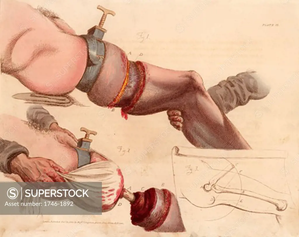 Amputation of the leg at the thigh. The tourniquet deadened the pain as well as reducing the flow of blood but was likely to cause serious tissue damage. From Illustrations of the Great Operations of Surgery by Charles Bell (London, 1821).