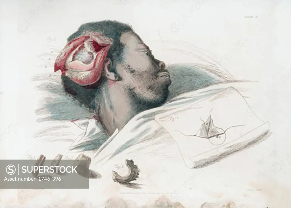 Wound in skull after trephination and removal of shattered bone. From Charles Bell The Great Operations of Surgery London, 1821. Etching by Thomas Landseer after Bell.