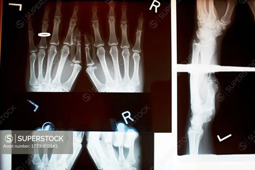 X ray image of bones in hand