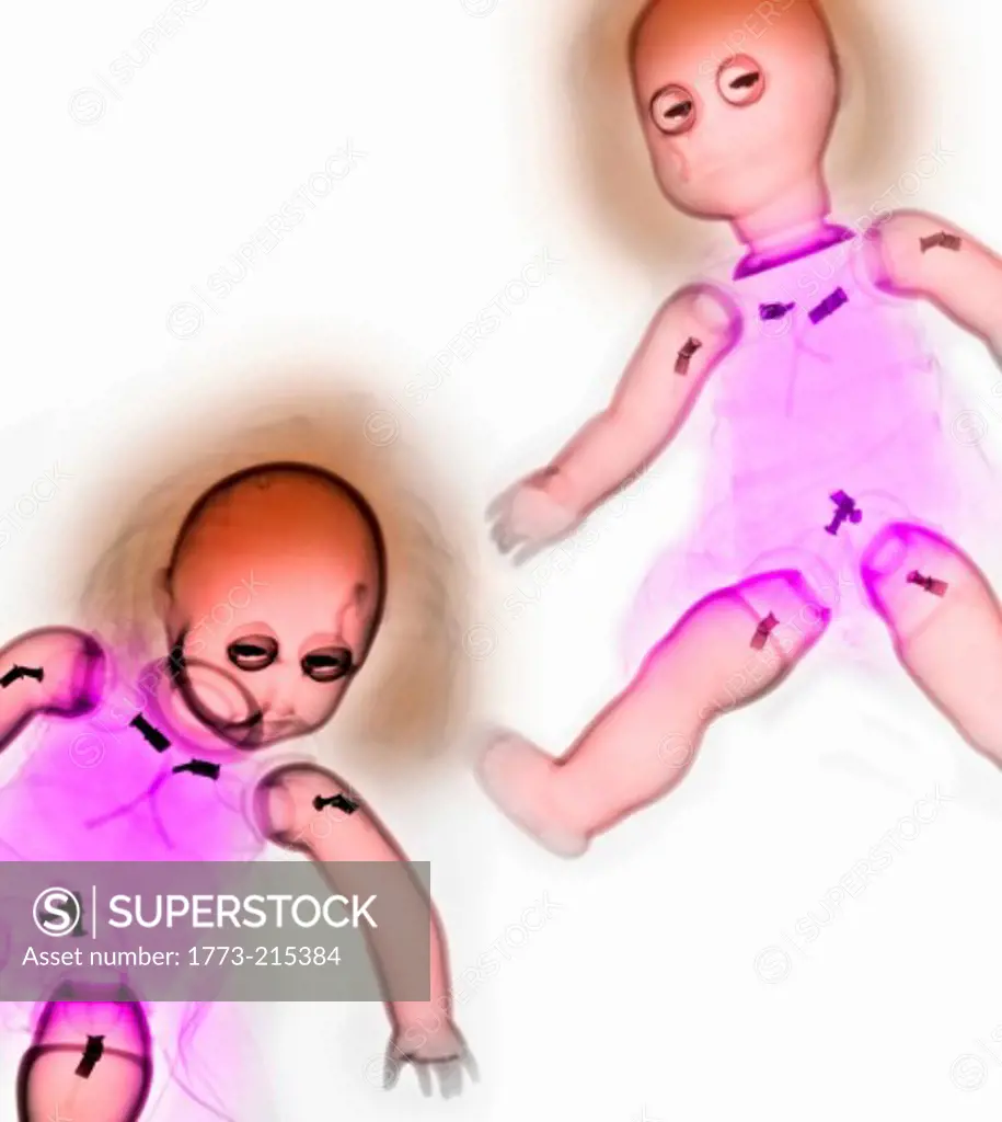 Colorized x-ray of two dolls