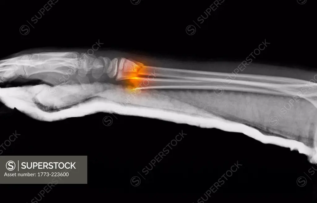 X-ray of forearm fracture of 11 year old boy