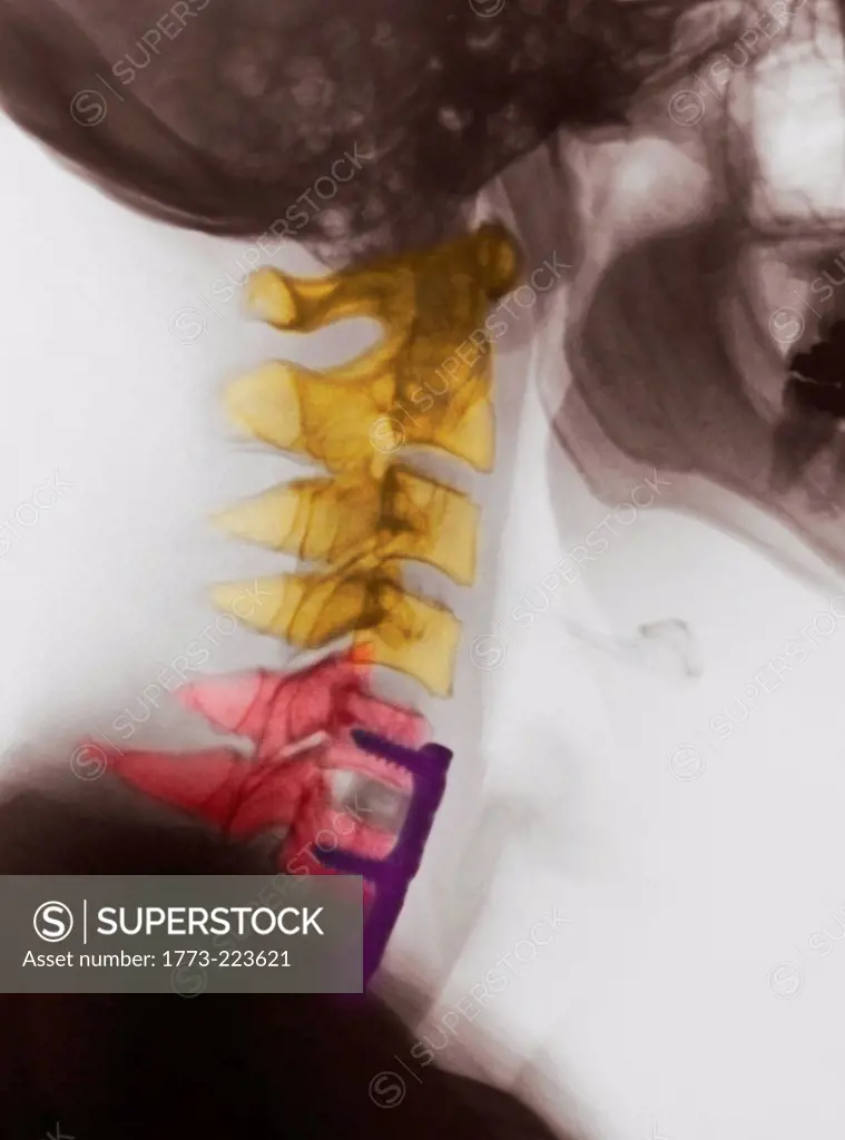 X-ray of neck showing spinal fusion
