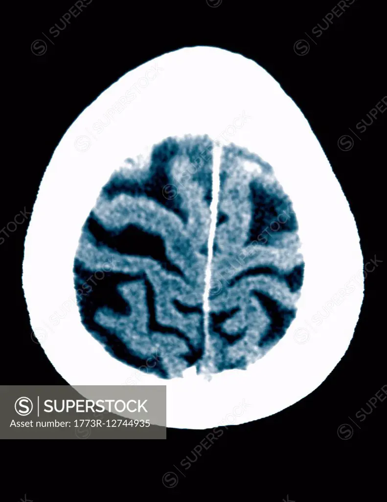 CT scan 84 year old male with Alzheimer's disease. CT shows brain atrophy with small gyri and large sulci