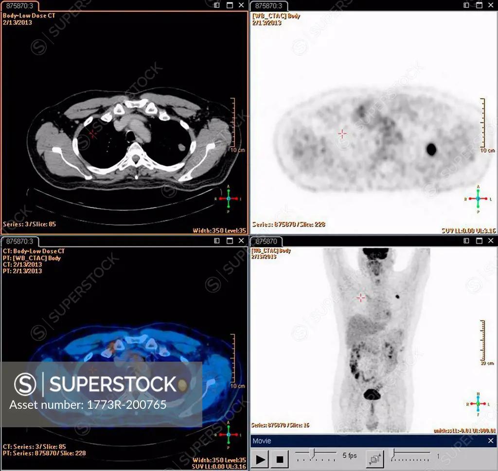 A composite Positron set of Emission Tomography (PET) scan images of the neck of a male patient aged 54. A tumour can be seen in the left upper lobe o...