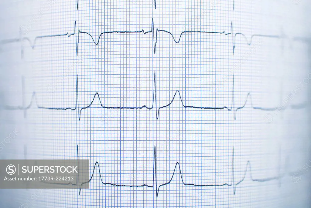 Healthy electrocardiogram