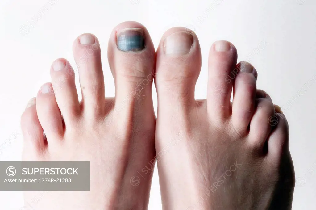 The big toe takes a toll after a season of skiing in Lake Tahoe, Nevada.