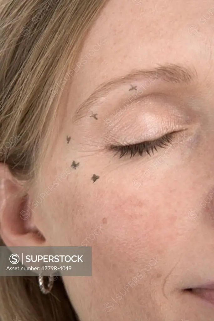 Marks around woman's eye