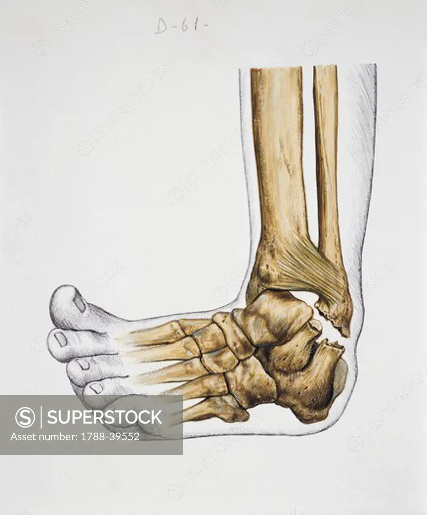 Medicine - Anatomy - Pathology - Musculoskeletal (locomotor) system - Joints - Bones. Tibio-tarsal sprain. Drawing