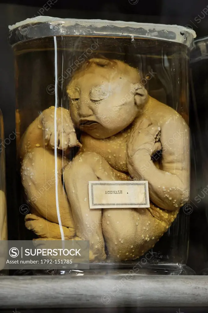 France, Herault, Montpellier, historical center, medecine university, Anatomy museum, fetus of the teratology collection which is the scientific study...