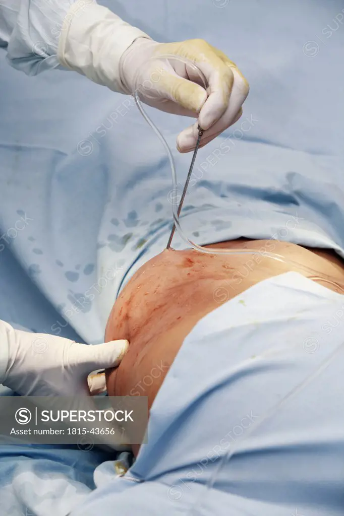 Surgeon performing fat loss surgery