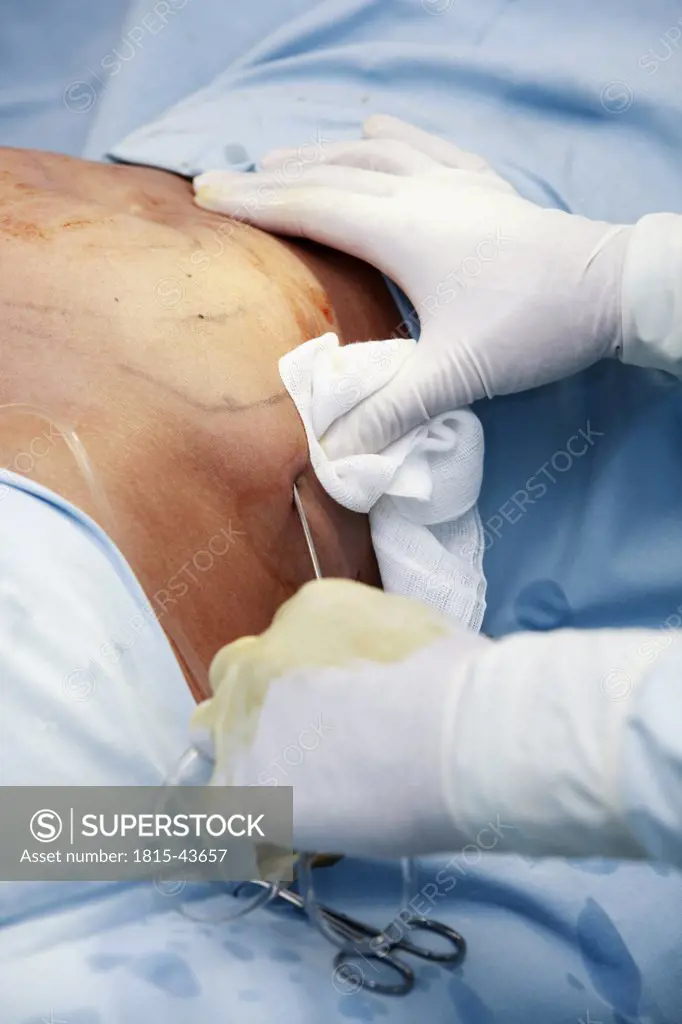 Surgeon performing fat loss surgery