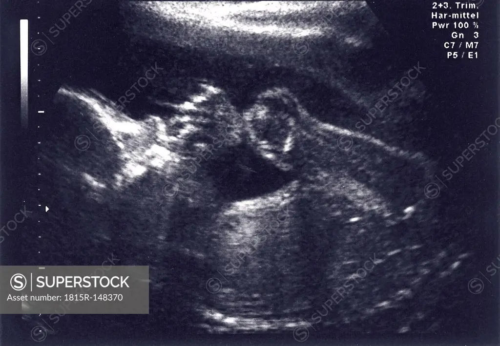 Germany, Kiel, ultrasonogram fetus, 6th month, female