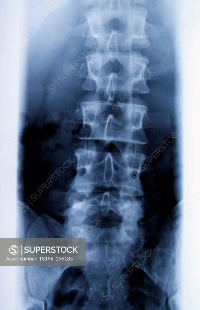 Radiograph of lumbar spine
