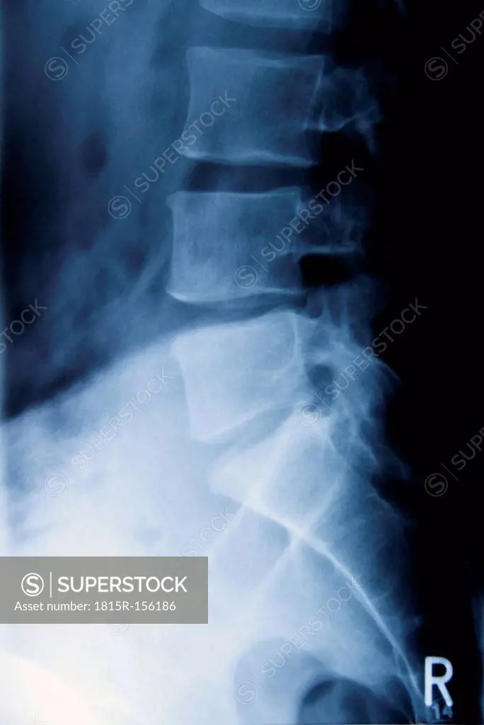 Radiograph of lumbar spine
