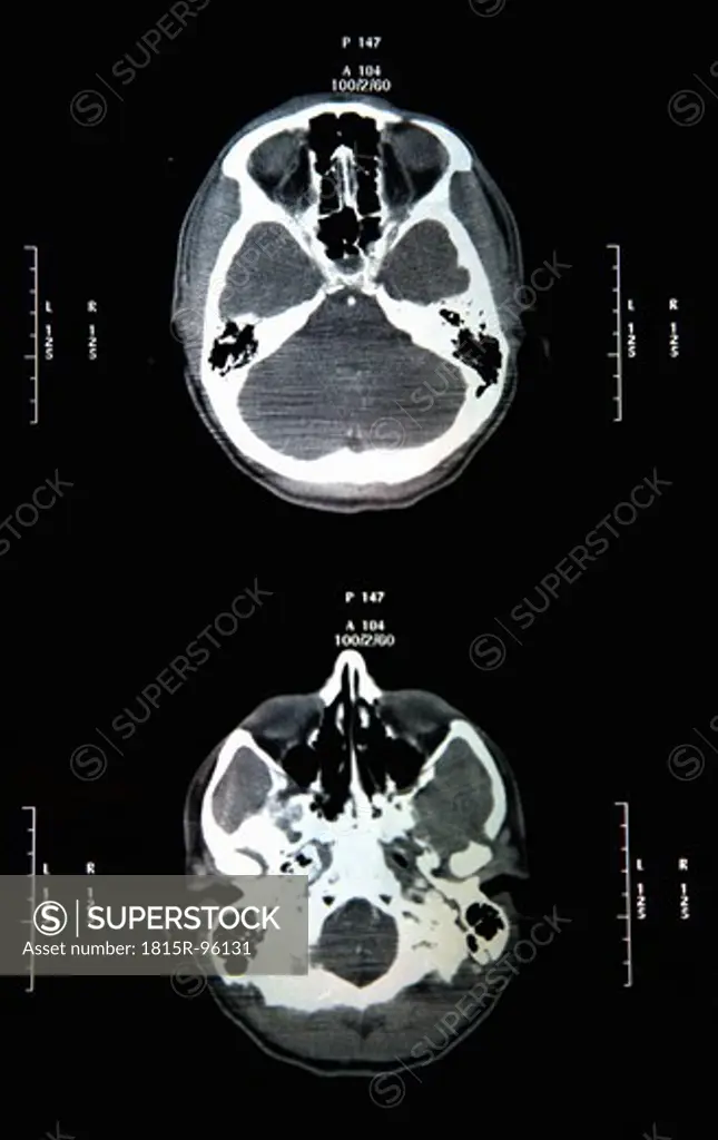 Ct scan report of head and skull, close up