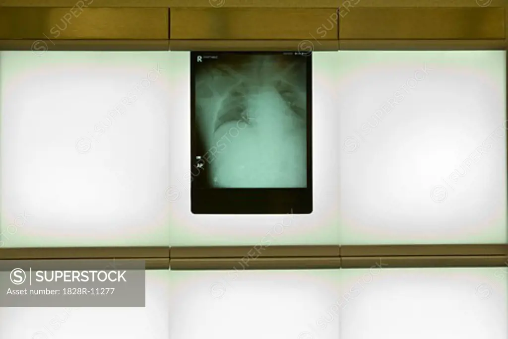 X-Ray on Lightbox   
