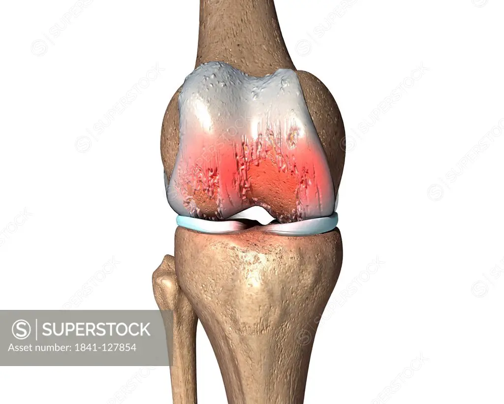 Illustration of an osteoarthritic knee