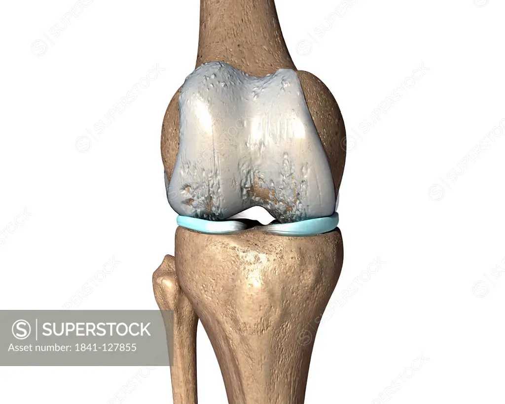 Illustration of an osteoarthritic knee
